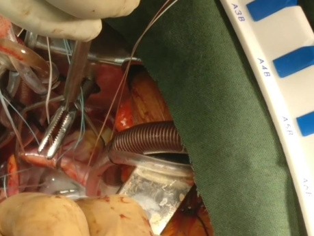 Cirugía cardíaca mínimamente invasiva (MICS), reparación de válvula mitral - técnica de canulación directa