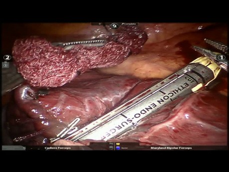 S3 Robótico: segmentectomía / resección del pulmón