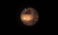 Evaluación posoperatoria de videoendoscopia de deglución