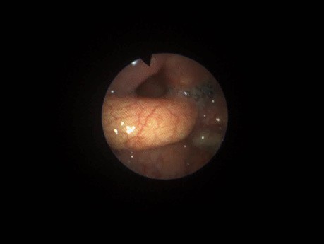 Evaluación posoperatoria de videoendoscopia de deglución