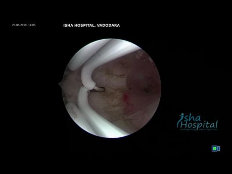 Resección histeroscópica del tabique tabique intrauterino completo hasta OS interno