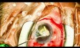 Intercambio de Lente Intraocular (LIO) dislocada con fijación Yamane, Parte 1