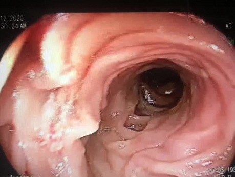 Estenosis de Anastomosis ESOFAGO-YEYUNO