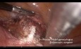 Cerclaje cervicoístmico laparoscópico