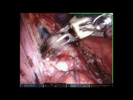 Lobectomía inferior izquierda para tratar la enfermedad pulmonar inflamatoria