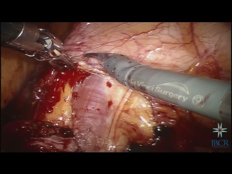 Reimplante ureteral asistido robóticamente con enganche de vejiga y psoas