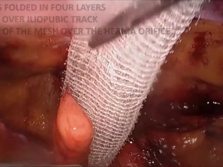 Tres tipos de malla ProGrip para cirugías de las hernia inguinal utilizando el método TAPP