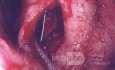 Implante de pared lateral izquierda - Síndrome de nariz vacía