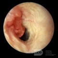 Adenocarcinoma del conducto auditivo externo