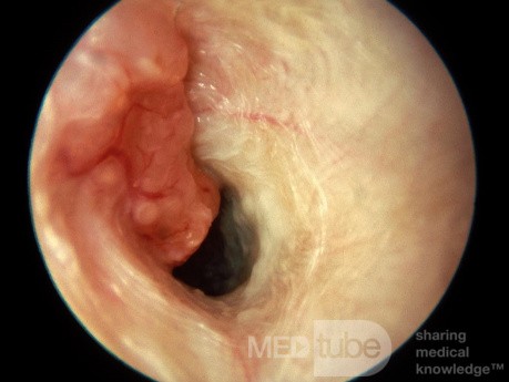 Adenocarcinoma del conducto auditivo externo