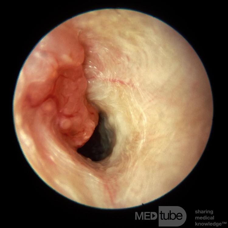 Adenocarcinoma del conducto auditivo externo