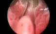 Greenlight HPS Prostatectomy - Part 1