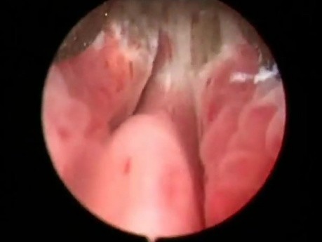 Prostatectomía HPS Greenlight - Parte 1