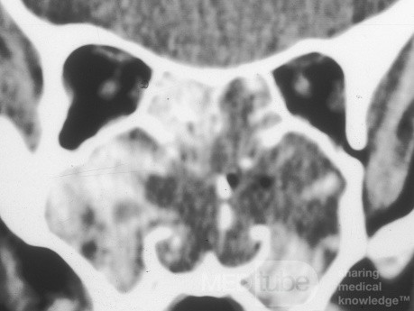 Sinusitis fúngica alérgica grave [tomografía computarizada]