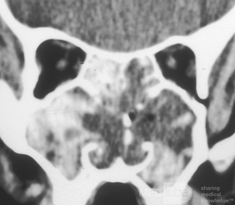 Sinusitis fúngica alérgica grave [tomografía computarizada]