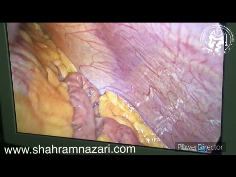 Neumatosis Intestinal