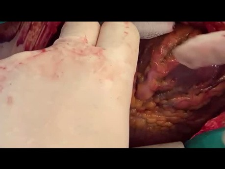 Paciente con un tumor enorme de aurícula izquierda y ventrículo izquierdo, posiblemente sarcoma hemangioma, sometido a resección y reconstrucción coronaria con injerto de vena safena
