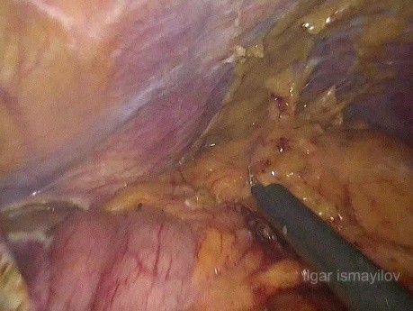 Gastrectomía total laparoscópica para la recurrencia en el estómago remanente después de gastrectomía parcial abierta
