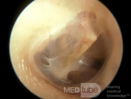 Engrosamiento fino de la membrana timpánica de la capa fibrosa