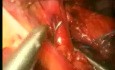 Funduplicatura de Nissen de la Hernia de Hiato