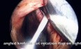 Reparación de perforación septal nasal