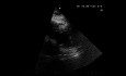 ECG y ecocardiografía de un paciente con anomalías del movimiento de la pared del VI