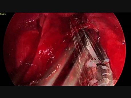 Lobectomía inferior izquierda por VATS sin intubación