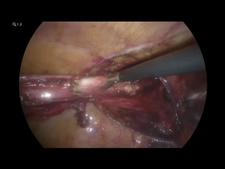 Hernia inguinoescrotal laparoscópica (colon sigmoide irreducible)