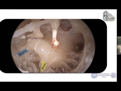Anatomía de la ventana redonda e implante coclear asistido por endoscopia