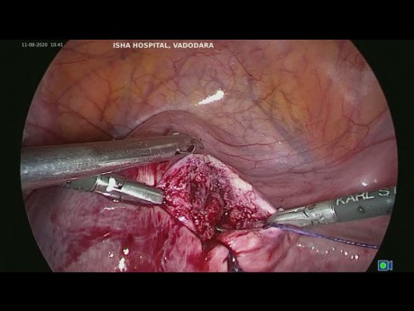 Manejo laparoscópico de adenomioma quístico 