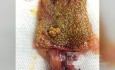Colesterolosis