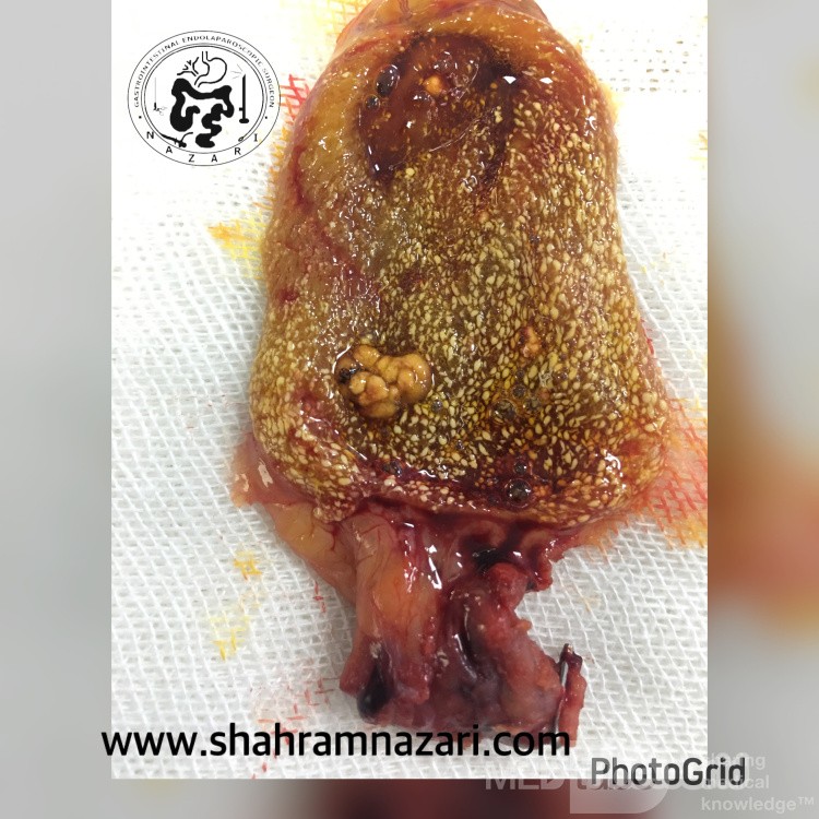 Colesterolosis