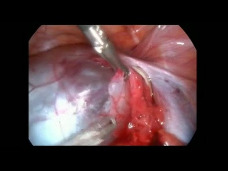 Cistectomía paratubárica laparoscópica
