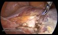 Histerectomía total laparoscópica - guía ESGE