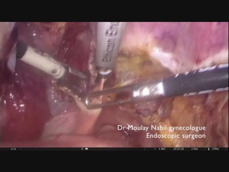Histerectomía radical para el cáncer de cuello uterino en etapa temprana