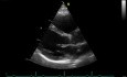 Ecocardiografía tridimensional en tiempo real: vista paraesternal en eje largo de la válvula mitral, vídeo n.º 2
