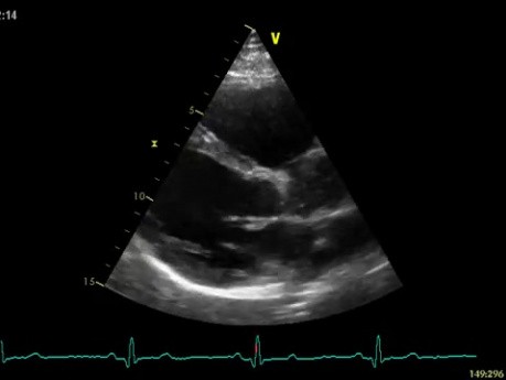 Ecocardiografía tridimensional en tiempo real: vista paraesternal en eje largo de la válvula mitral, vídeo n.º 2