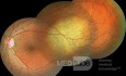 Metastasis de cáncer de pulmon en el globo ocular