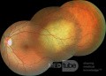 Metastasis de cáncer de pulmon en el globo ocular