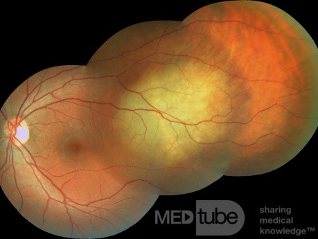 Metastasis de cáncer de pulmon en el globo ocular