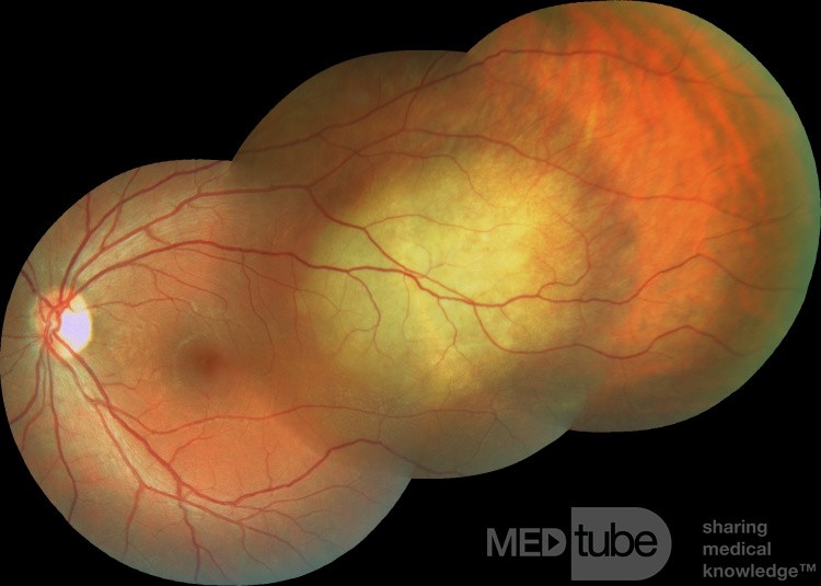 Metastasis de cáncer de pulmon en el globo ocular