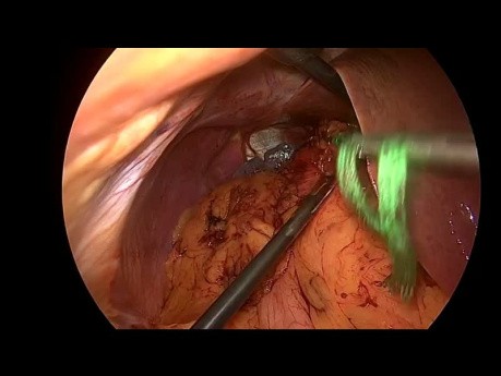 Situs Inversus Toupet