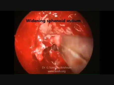 Rinosinusitis fúngica alérgica bilateral