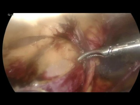Hernia inguinal izquierda - Reparación laparoscópica transabdominal preperitoneal con placa 