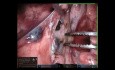 Segmentectomía S6, cirugía pulmonar robótica