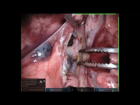 Segmentectomía S6, cirugía pulmonar robótica