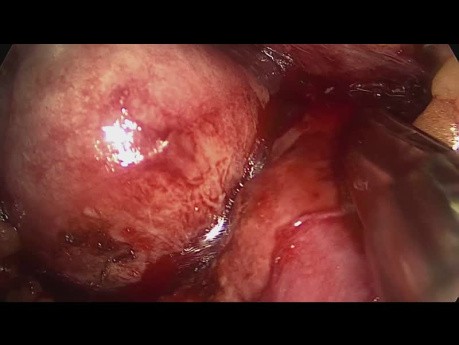 Nefrectomía parcial retroperitoneoscópica