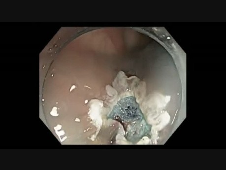 Colonoscopia - resección mucosa endoscópica de una lesión cecal sutil