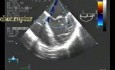 Endocarditis infecciosa: rotura de cuerdas de ambas valvas mitrales con insuficiencia mitral grave (ETE)