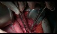 Tratamiento quirúrgico supramesocólico del pseudomixoma peritoneo